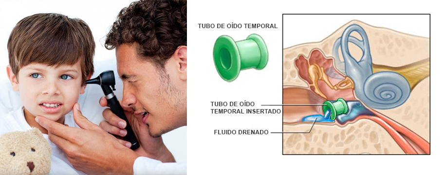 Operacion de Oidos en Monterrey