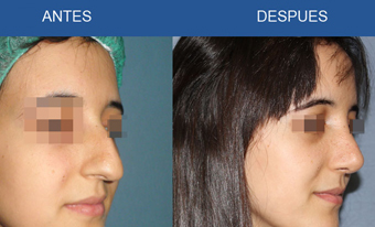 Rinoplastia en Monterrey